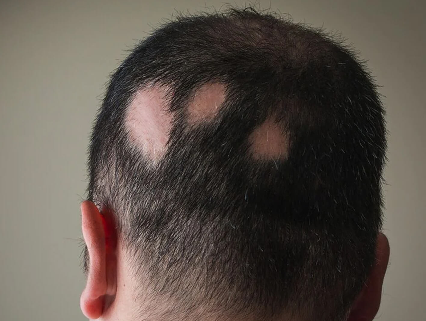 Hair regrowth treatment at ryan